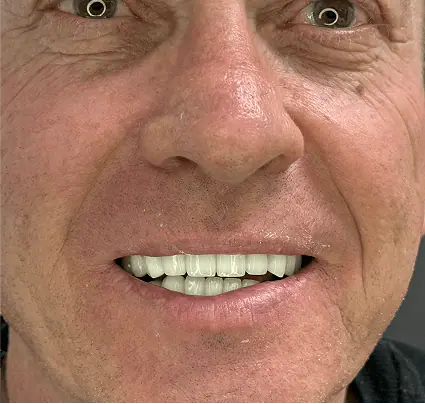 After: the patient's smile with a full set of even, white teeth