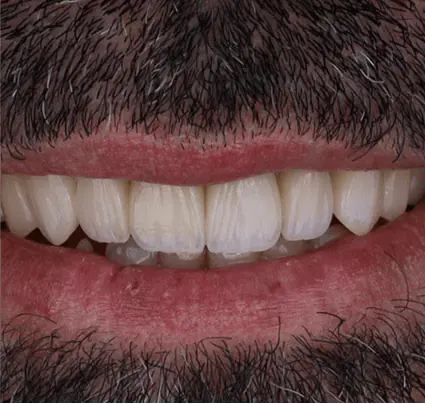 After: a bright, even smile