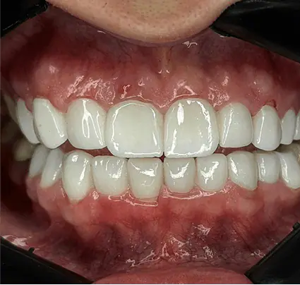After: close-up of straight, white upper and lower teeth