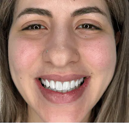 After: the patient smiling with even, white teeth