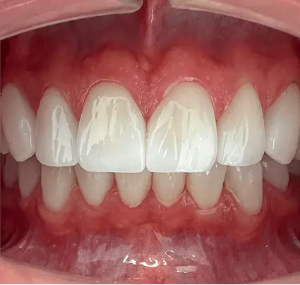 After: close-up of new white front teeth