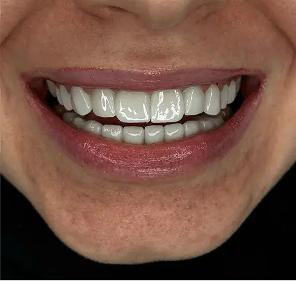 After: a smile with even, white teeth