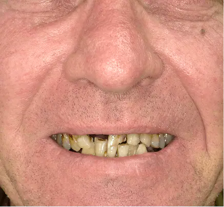 Before: the patient's smile with worn, stained and missing teeth