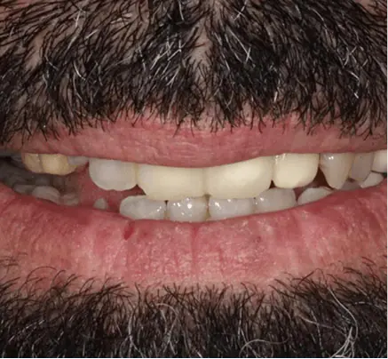 Before: a smile with short, uneven teeth