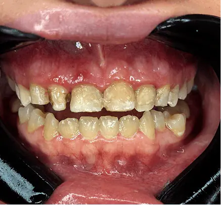 Before: close-up of worn, discolored upper and lower teeth
