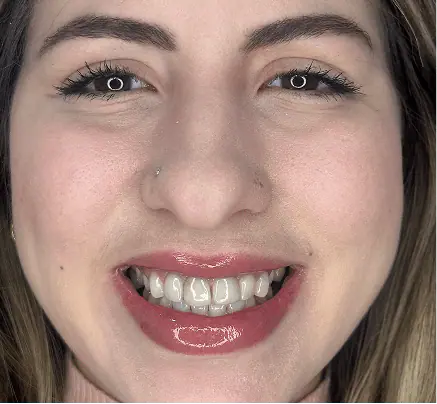 Before: the patient smiling before treatment