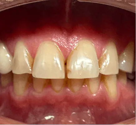 Before: close-up of uneven front teeth