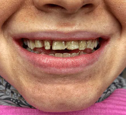 Before: a smile with chipped, discolored teeth