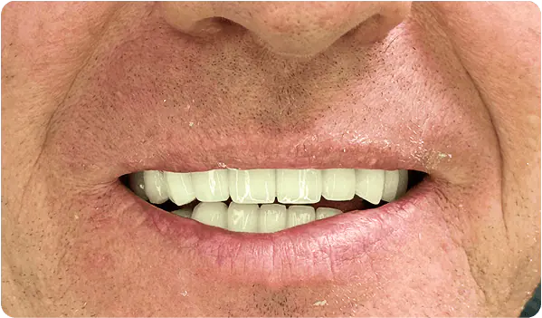 After: the patient's smile with new, even teeth