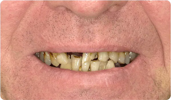 Before: the patient's smile with worn and missing teeth